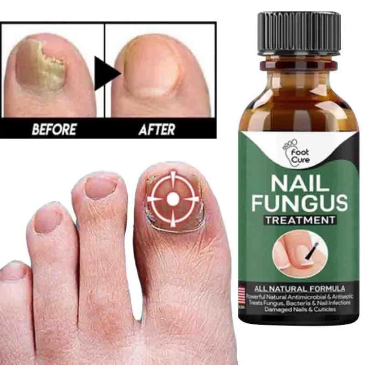 Fast Nail Fungal Treatments Nail Repair Essences Serum Care Treatments Foot Nail Fungus Removal Gel Paronychia Onychomycosis